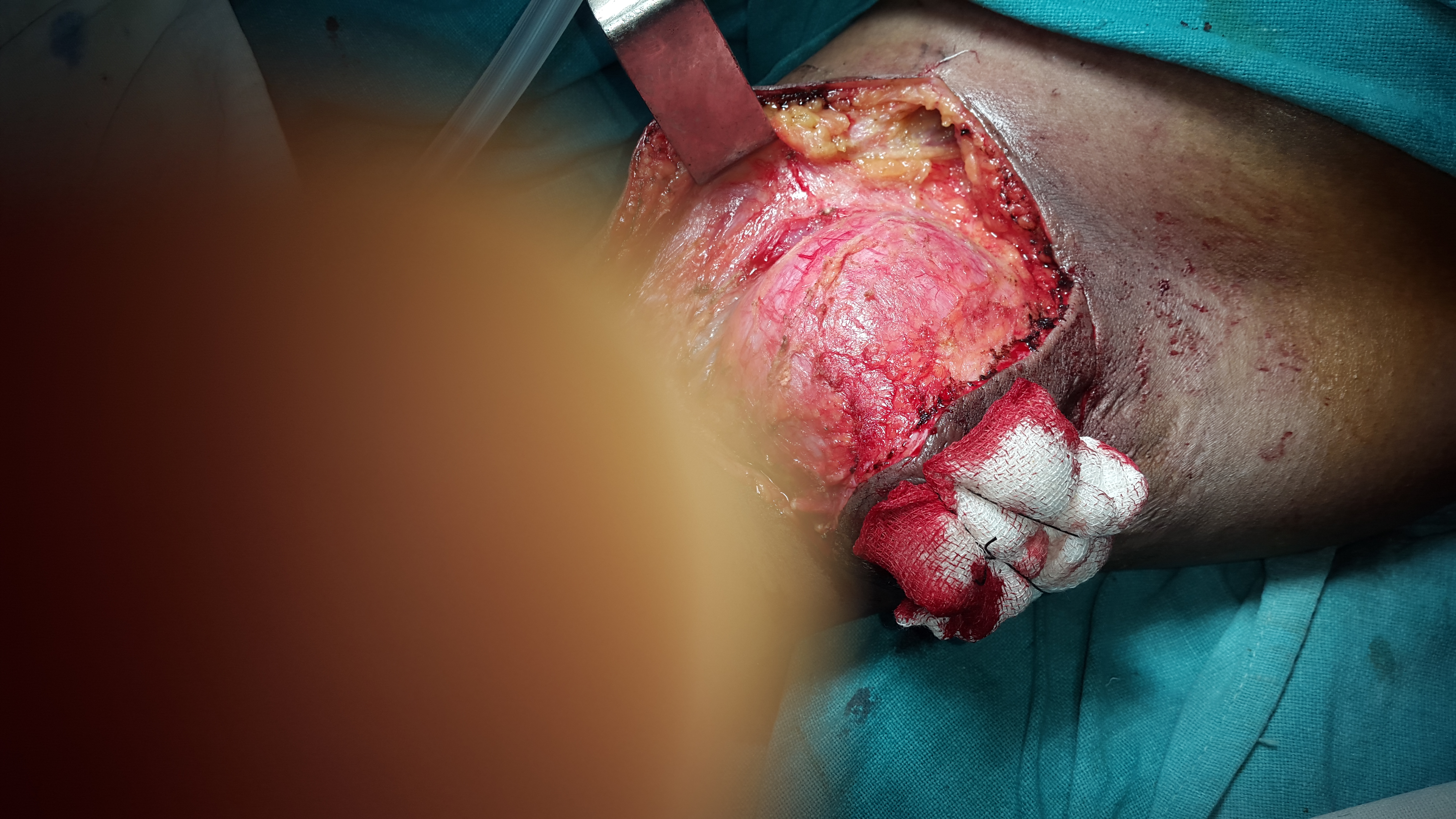 Cystic Hygroma